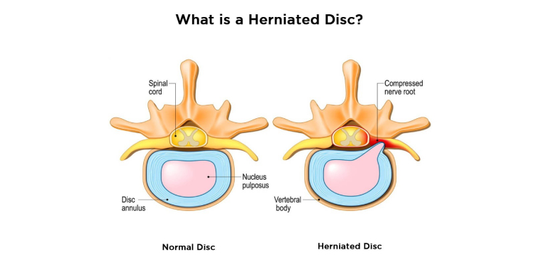 herniated-disc-back.jpg