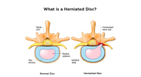 herniated-disc-home.jpg